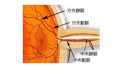 視網膜中央靜脈阻塞的癥狀
