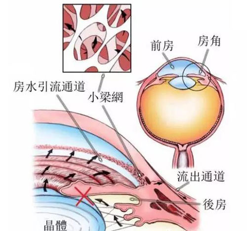 青光眼白內障聯合術