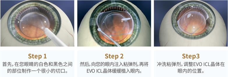 近視手術術后視力會反彈嗎