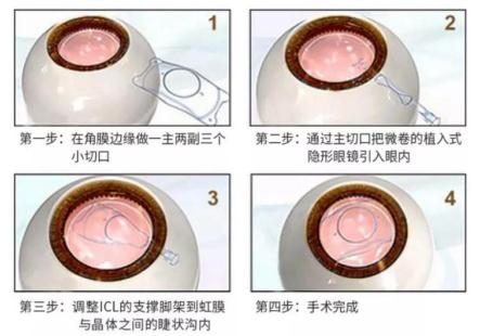 ICL手術安全嗎？