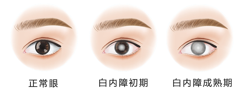 戴眼鏡后近視度數(shù)增長快是什么原因？