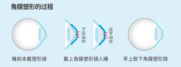 昆明哪里驗(yàn)光配鏡準(zhǔn)確？
