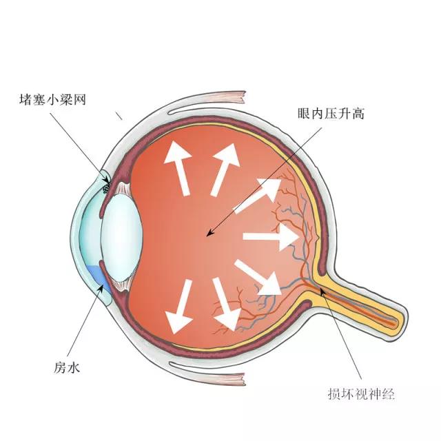 青光眼可以治好嗎？
