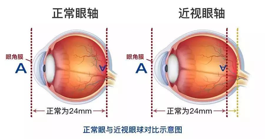 icl手術(shù)風(fēng)險(xiǎn)大嗎？
