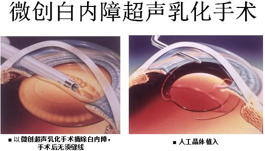 昆明白內障手術費用