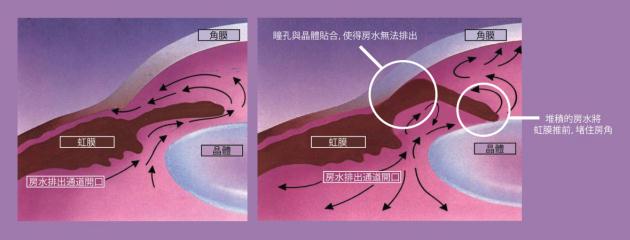 急性青光眼和慢性青光眼的區別