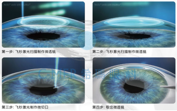 全飛秒激光近視手術